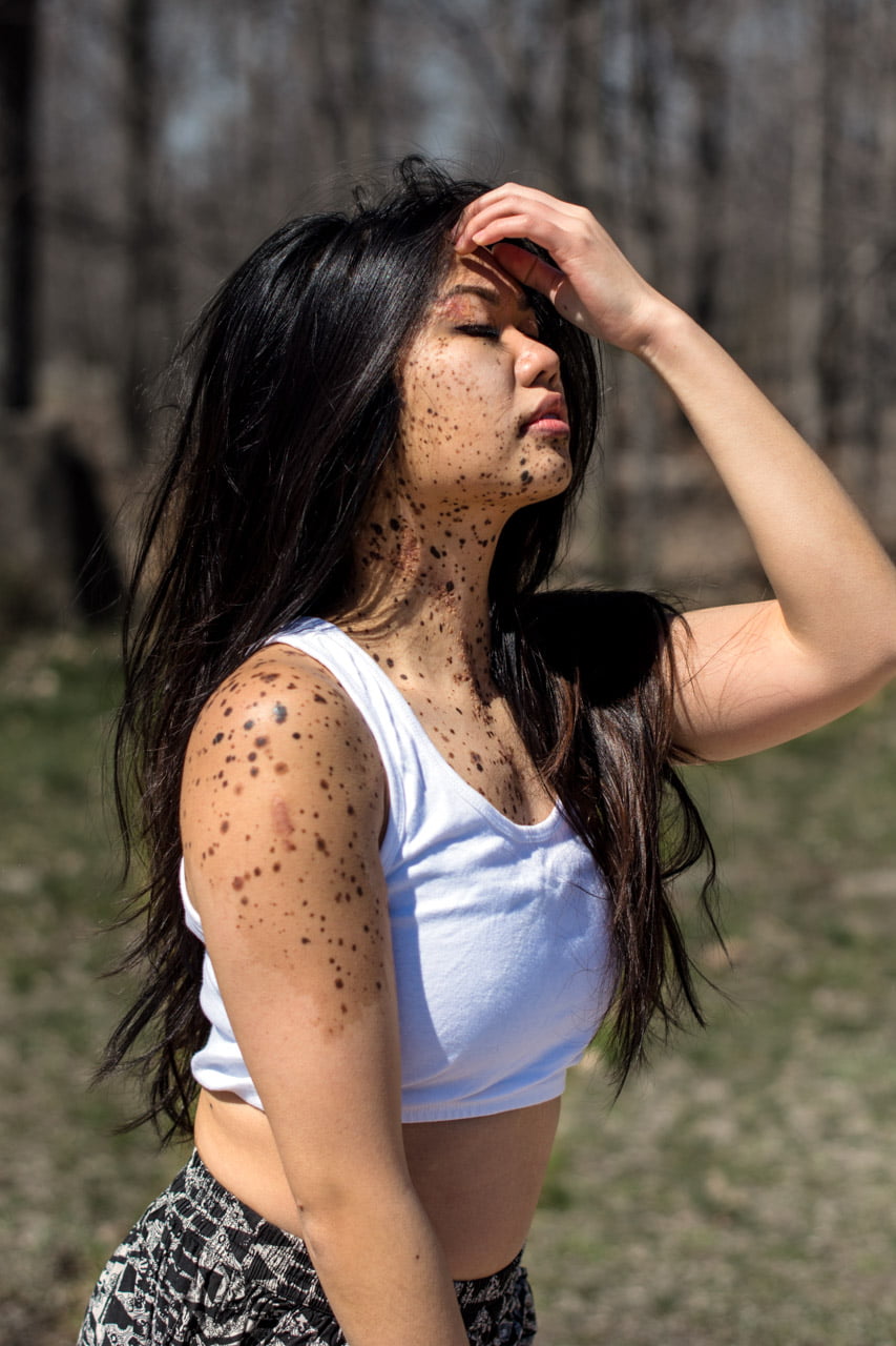 Skin Disorder