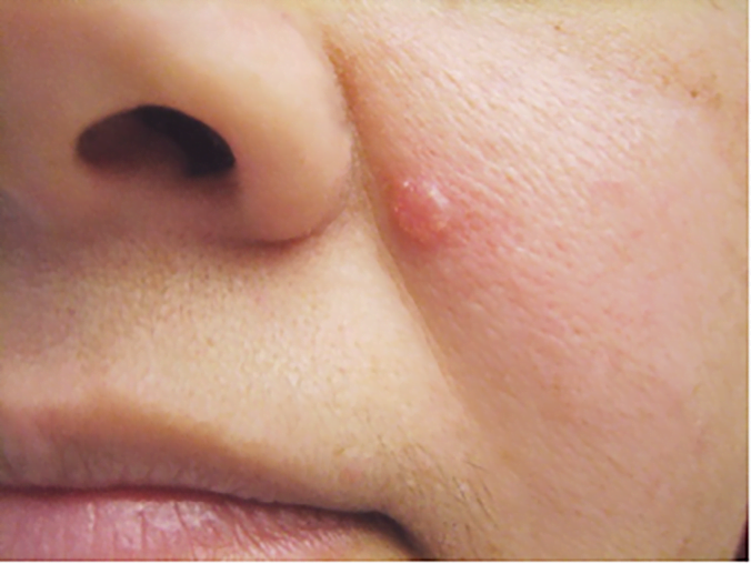 Drug Shows Promise Against Rare, Aggressive Skin Cancer