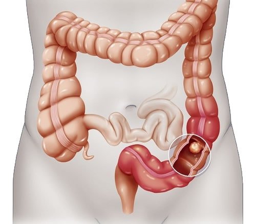 Small Study Supports New Stool-Based Colon Cancer Test